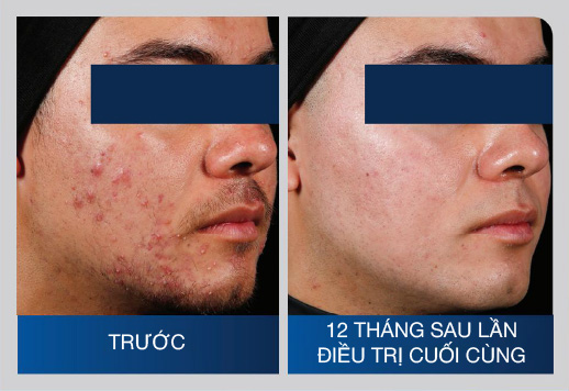 Hình ảnh trước và sau khi điều trị mụn 2