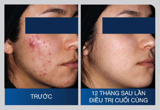 Hình ảnh trước và sau khi điều trị mụn 1